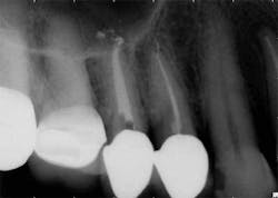 15apr2bclandwehr Rootcanals 04b 15apr2bclandwehr Rootcanals 04b