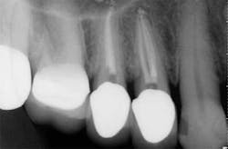 15apr2bclandwehr Rootcanals 04c 15apr2bclandwehr Rootcanals 04c