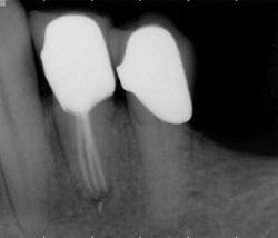 15apr2bclandwehr Rootcanals 05a 15apr2bclandwehr Rootcanals 05a
