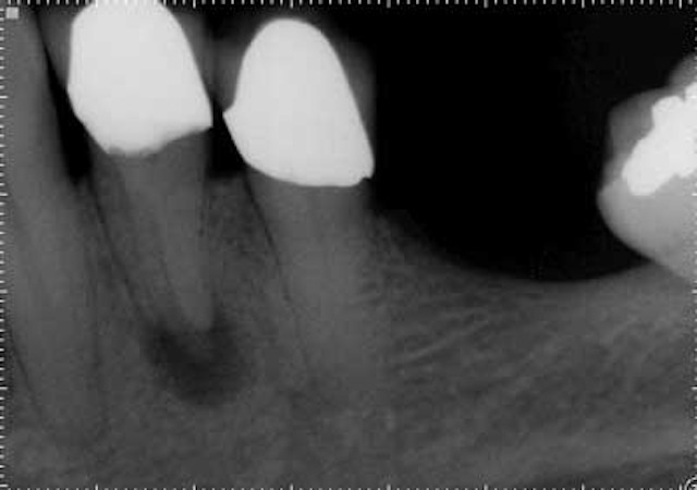 15apr2bclandwehr Rootcanals 05a2