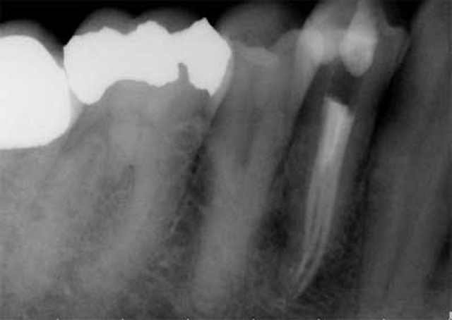 15apr2bclandwehr Rootcanals 05b