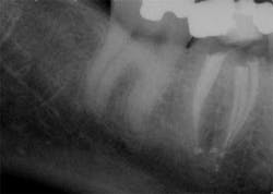 15apr2bclandwehr Rootcanals 06a 15apr2bclandwehr Rootcanals 06a