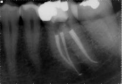 15apr2bclandwehr Rootcanals 06b 15apr2bclandwehr Rootcanals 06b