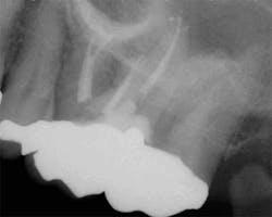 15apr2bclandwehr Rootcanals 07aa 15apr2bclandwehr Rootcanals 07aa