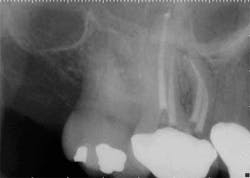 15apr2bclandwehr Rootcanals 07b 15apr2bclandwehr Rootcanals 07b