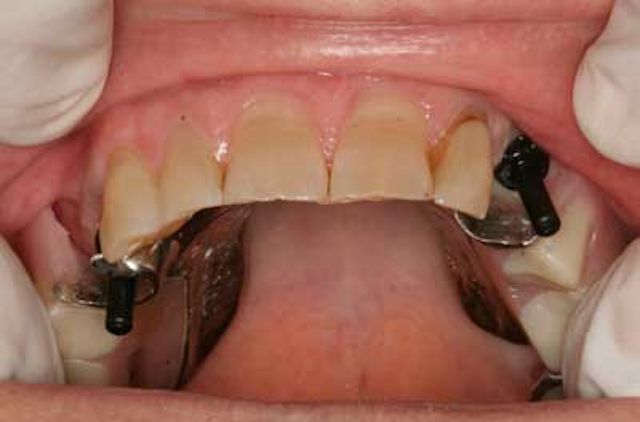 Claspless, removable partial dentures using implant-supported Locator ...