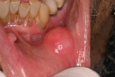 hpv lower lip