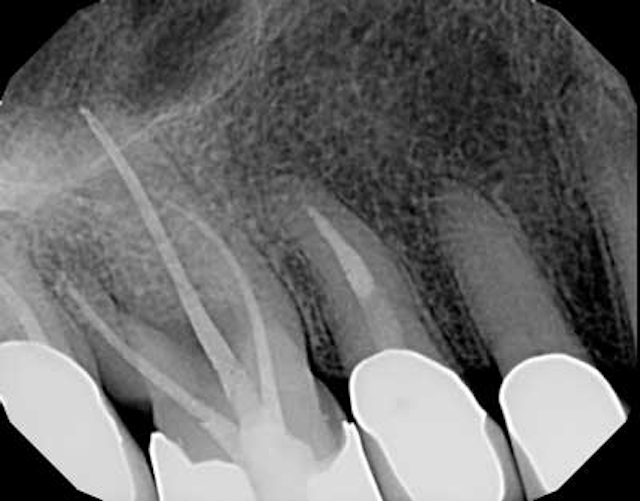 Endodontic insight into safety, efficiency, and cost savings DentistryIQ
