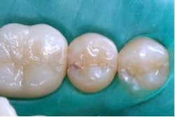 2014blank3mscotchbondselectiveetch01 2014blank3mscotchbondselectiveetch01