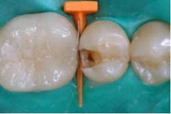 2014blank3mscotchbondselectiveetch02 2014blank3mscotchbondselectiveetch02