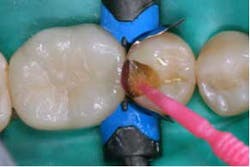 2014blank3mscotchbondselectiveetch04 2014blank3mscotchbondselectiveetch04