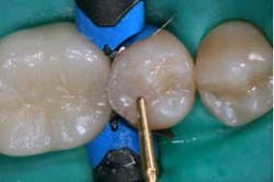 2014blank3mscotchbondselectiveetch05 2014blank3mscotchbondselectiveetch05