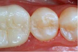 2014blank3mscotchbondselectiveetch06 2014blank3mscotchbondselectiveetch06