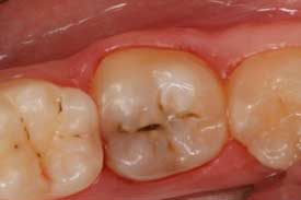 The 3 Modes Of A Universal Adhesive: Part I -- Self-etch | Dentistry IQ