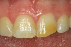 The 3 Modes Of A Universal Adhesive: Part II -- Total-etch | Dentistry IQ