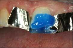 2014blank3mscotchbondtotaletch03 2014blank3mscotchbondtotaletch03