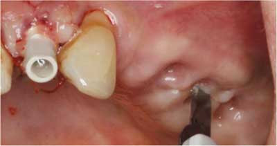 Choosing a combination of dental implants and drilling procedures that