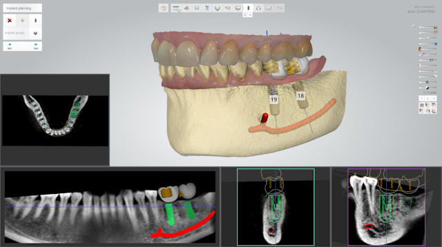 3shape Implant Studio 2014