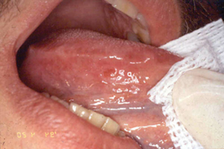 Dental Associations Urge Regular Oral Cancer Examinations For Early Detection Dentistryiq