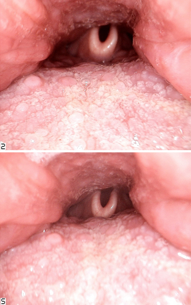 base of tongue cancer and hpv)