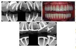 All On Four Implant All On Four Implant