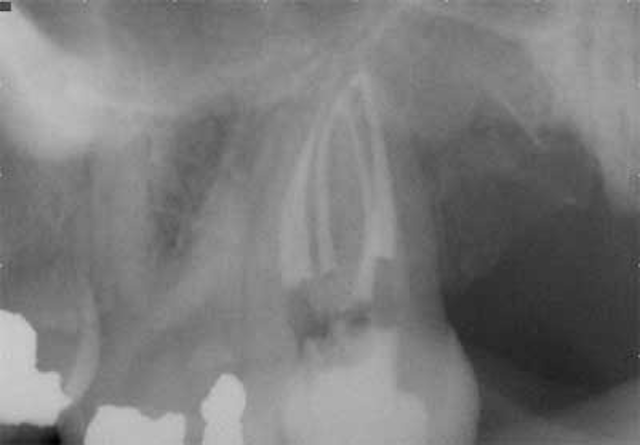 Apr2bclandwehr Rootcanals 07a
