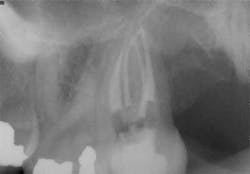Apr2bclandwehr Rootcanals 07a Apr2bclandwehr Rootcanals 07a