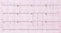 Atrial Fibrillation Fo Atrial Fibrillation Fo