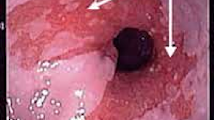Barrett Esophagus Fo