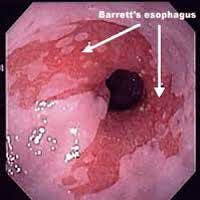 Barrett Esophagus Fo Barrett Esophagus Fo