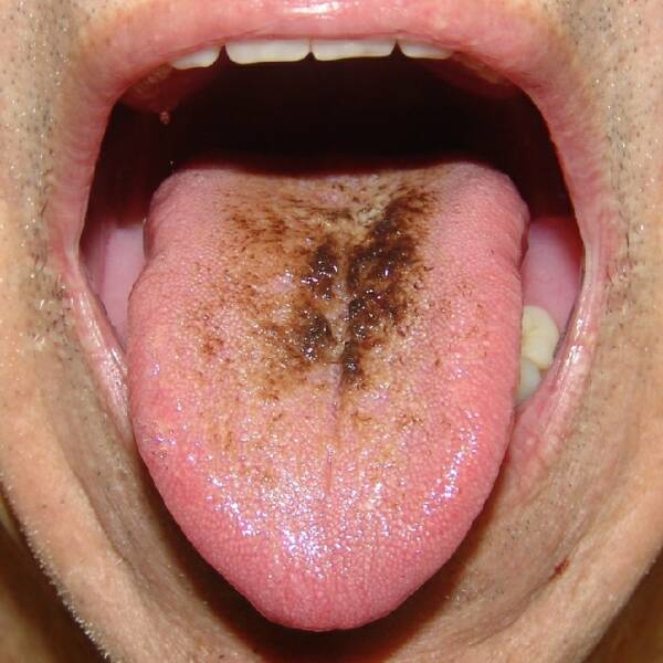 Black Hairy Tongue 700 Sq