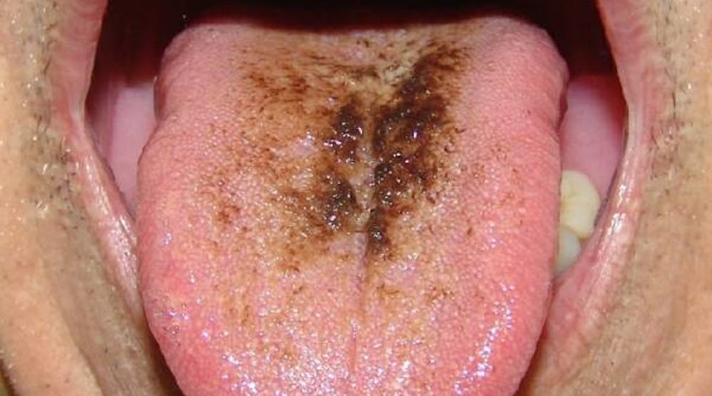 Black Hairy Tongue 700 Sq