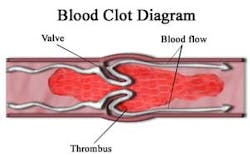 Blood Clot Fo Blood Clot Fo
