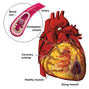 Cardiovascular Disease Diagram Fo
