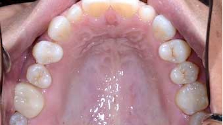 Carson Undersizedteethandorthodontics