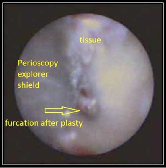 Clean Furcation Fo