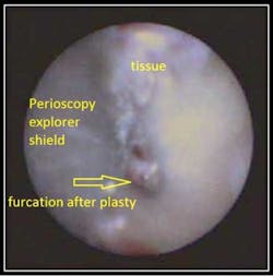 Clean Furcation Fo Clean Furcation Fo