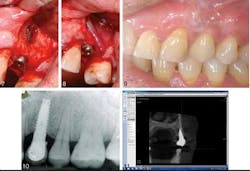 Completebonefilljoi Completebonefilljoi