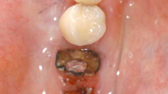 Dodging the dreaded dry socket: Tips on preventing this painful possibility | DentistryIQ Dodging the dreaded dry socket: Tips on preventing this painful possibility | DentistryIQ