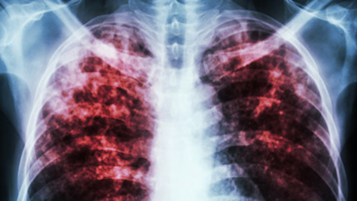 Content Dam Diq Online Articles 2015 12 Tuberculosis Thumb