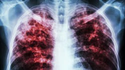 Content Dam Diq Online Articles 2015 12 Tuberculosis Thumb Content Dam Diq Online Articles 2015 12 Tuberculosis Thumb