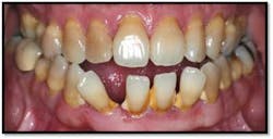 Cs1 Pretx5 Fo Cs1 Pretx5 Fo