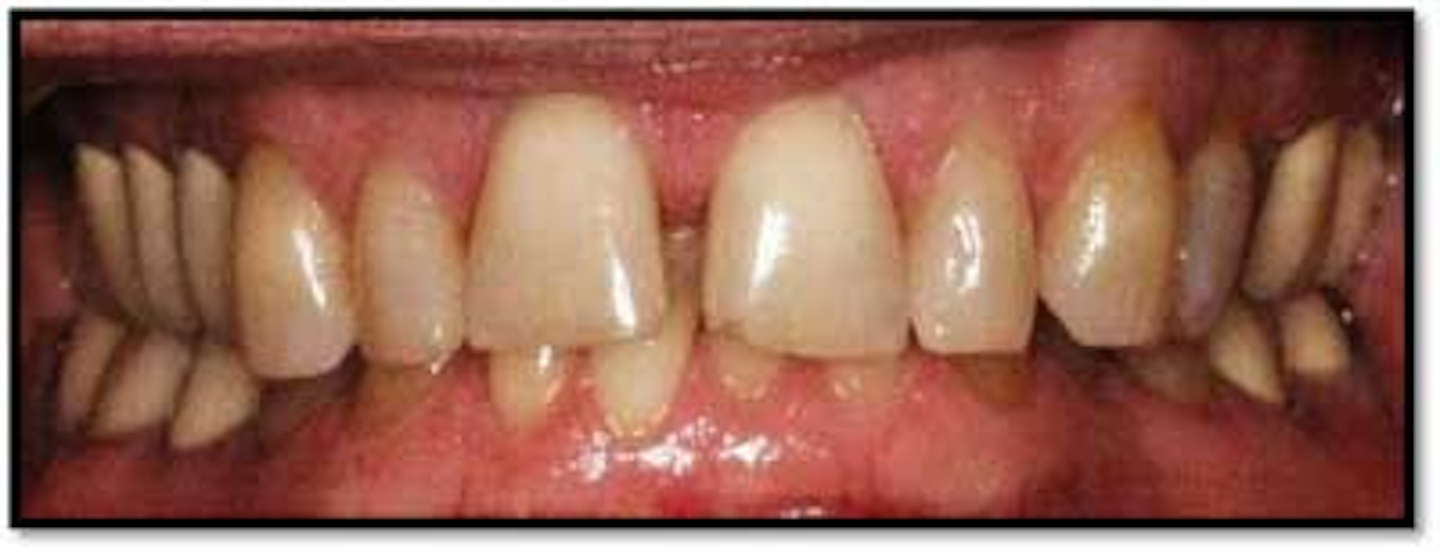 Case study use of perioscopy and LANAP for treatment of moderate periodontal disease DentistryIQ