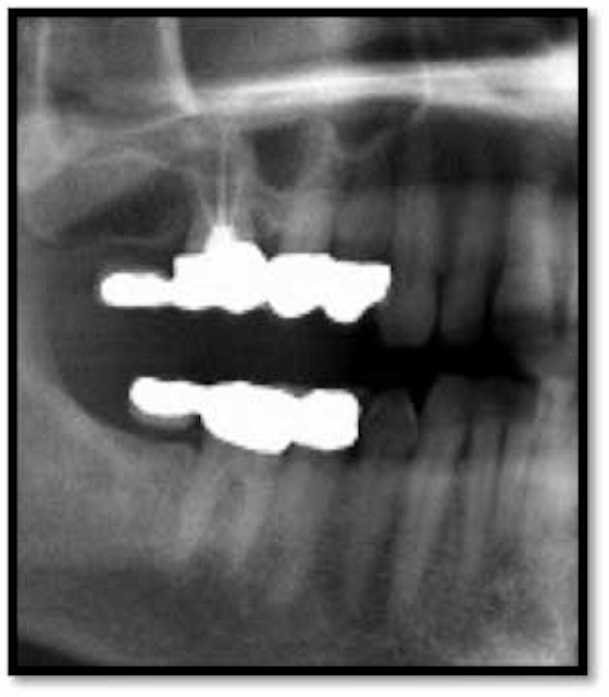 Case study use of perioscopy and LANAP for treatment of moderate periodontal disease DentistryIQ