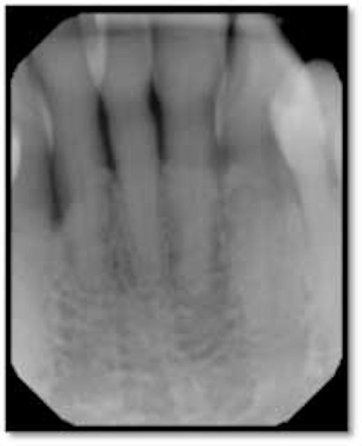 Case study use of perioscopy and LANAP for treatment of advanced