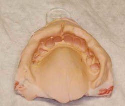 Dental Impressions Dental Impressions