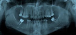 Dental X Ray Dental X Ray