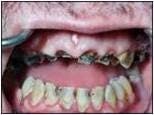 Destroyed Teeth Fo Destroyed Teeth Fo