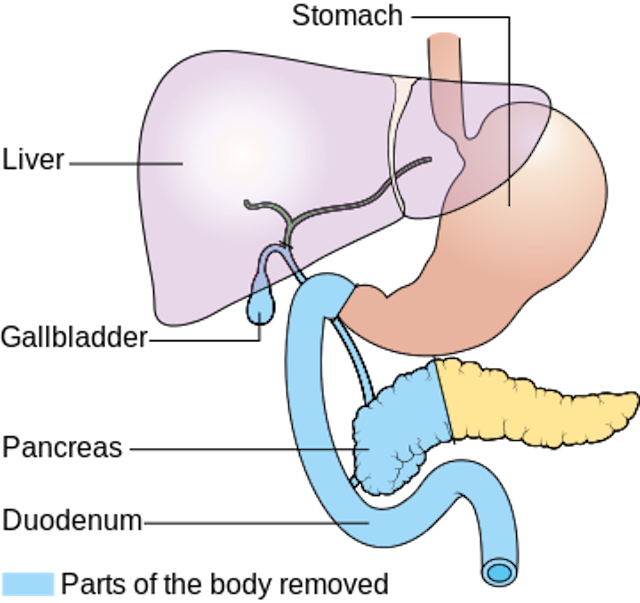 Diagram Showing The Parts Removed With A Whipple S Operation Cruk 337 svg