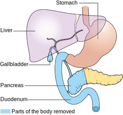 Diagram Showing The Parts Removed With A Whipple S Operation Cruk 337 svg Diagram Showing The Parts Removed With A Whipple S Operation Cruk 337 svg